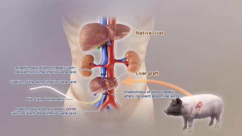 全球首例！中国团队成功将基因编辑猪肝脏移植到人体(图1)