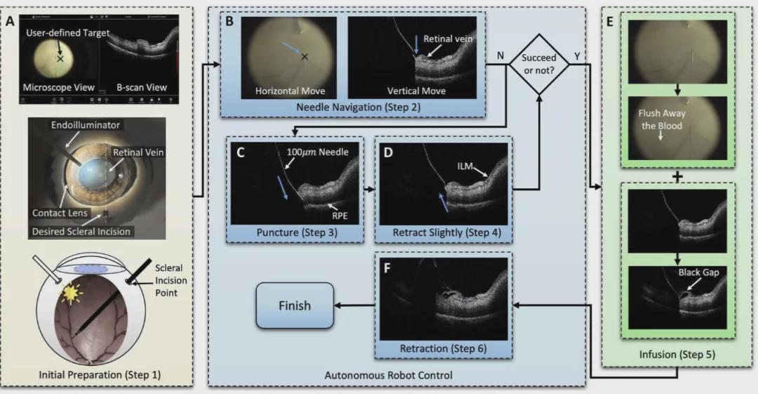 顶刊重磅！失明患者新希望！机器人自主视网膜静脉插管系统来了(图3)